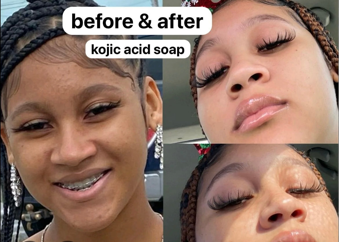 Savon Kojie san skin